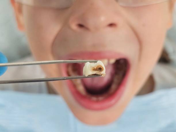 Best Emergency Wisdom Tooth Extraction in Waimanalo, HI